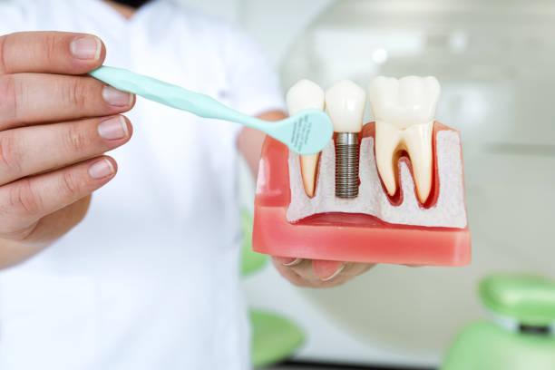 Dental Implants Clinic in Mumbai