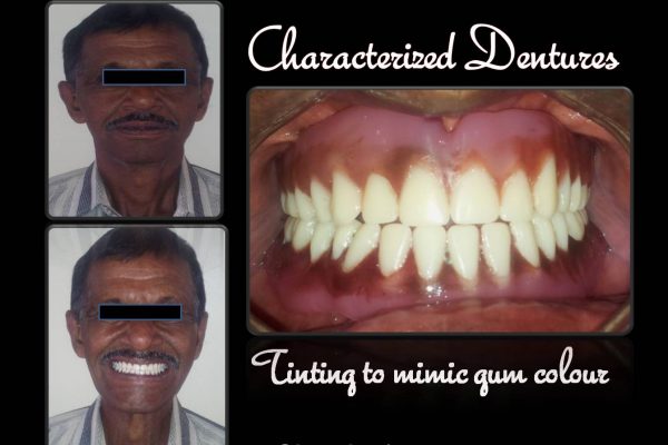 Characterised Dentures
