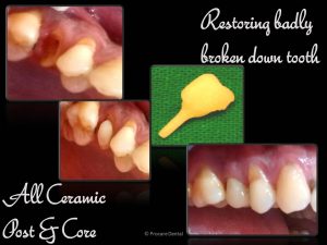 Restoration of broken tooth