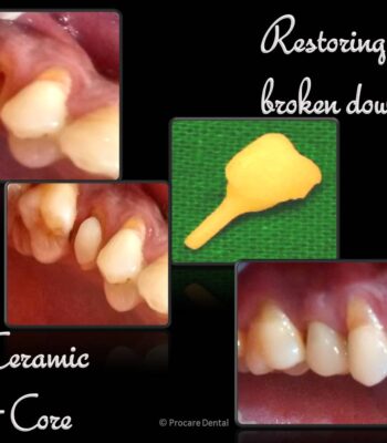 Restoration of broken tooth
