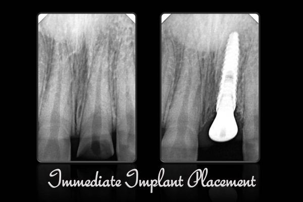 Immediate Implant Placement