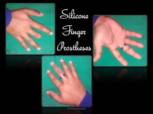 Silicone Finger Prostheses
