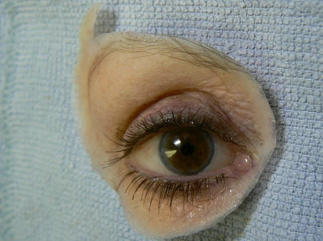 Eye Maxillofacial Prostheses