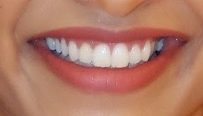 Cosmetic Dentistry For Female