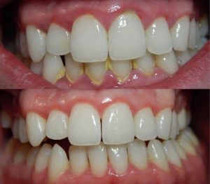 Teeth Whitening Service in Mumbai