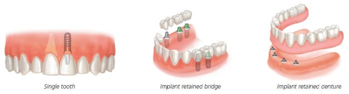 Dental Implant Clinic in Mumbai