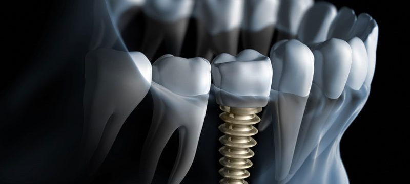 Dental Implants Are The Best Solution For Your Lost Smiles