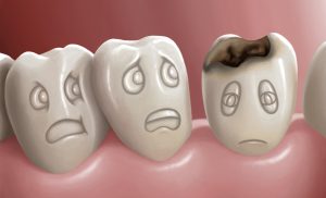 Tooth Decay Is A Problem That Affects A Majority Of The Population