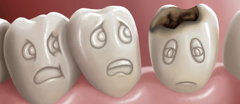 Tooth Decay Is A Problem That Affects A Majority Of The Population