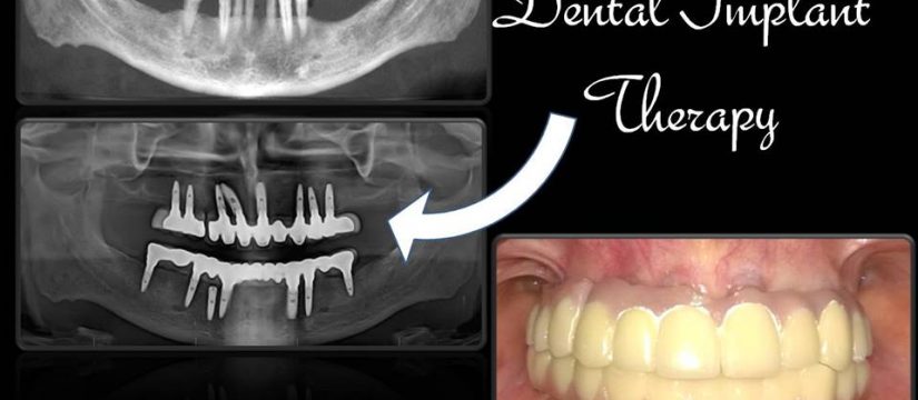 Why Dental Implants Are The Next Big Thing For Dental Clinics?