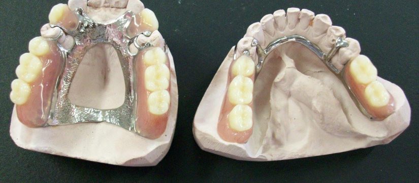 Cast Partial Dentures: All You Need To Know About Cast Partial Dentures