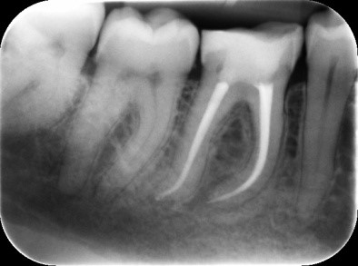 Root Canal Treatment - Pro Care Dental