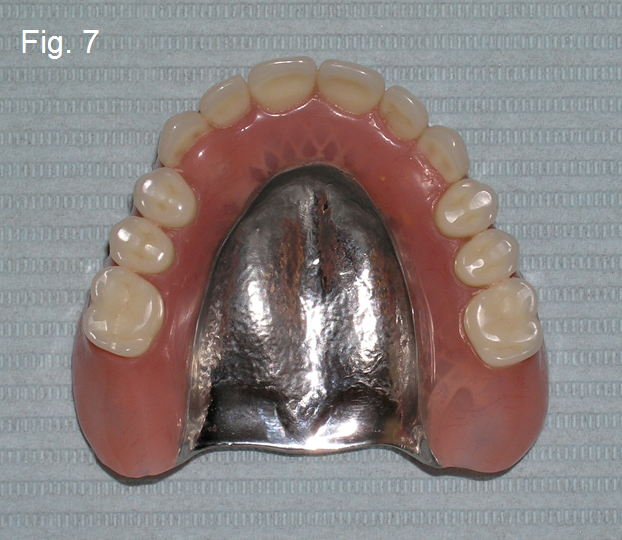 Metallic Denture