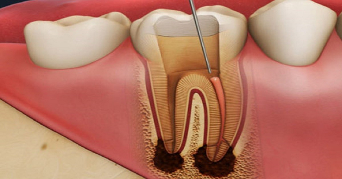 Root Canal Treatment in Mumbai