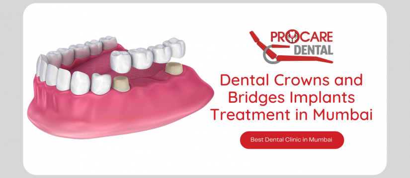 Dental Crowns and Bridges Implants Treatment in Mumbai