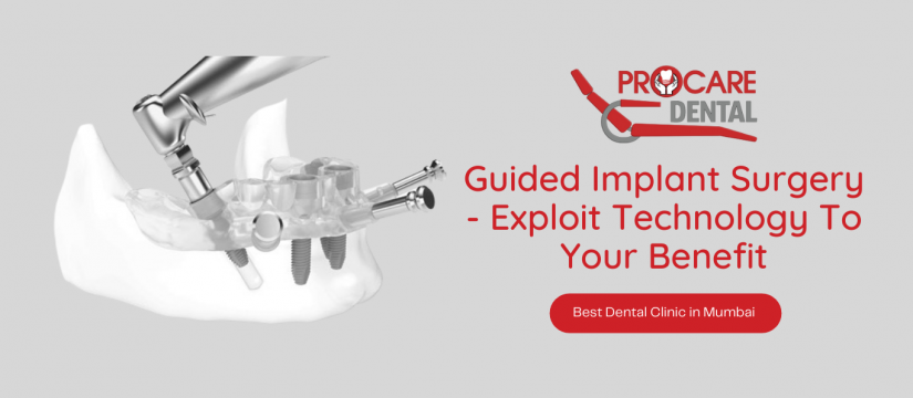 Guided Implant Surgery - Exploit Technology To Your Benefit