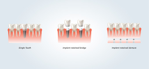 Dental Implant Treatment: Three Different Treatment Options