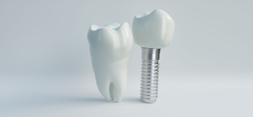 Titanium Implant: How Long Does An Implant Last?