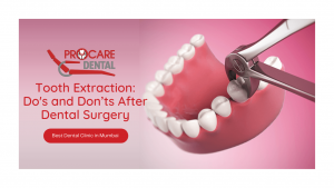 Tooth Extraction: Do's and Don’ts After Dental Surgery
