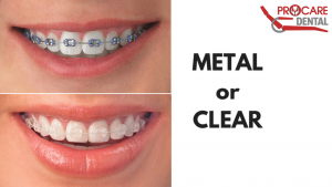 Bringing Teeth Into Alignment With Orthodontic Treatment (Braces)