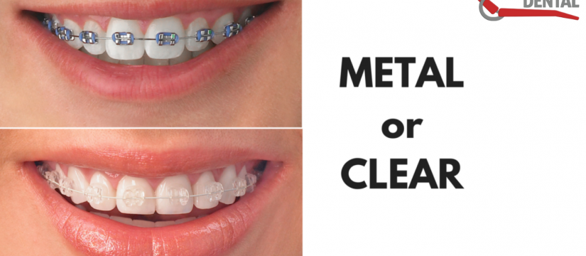 Bringing Teeth Into Alignment With Orthodontic Treatment (Braces)