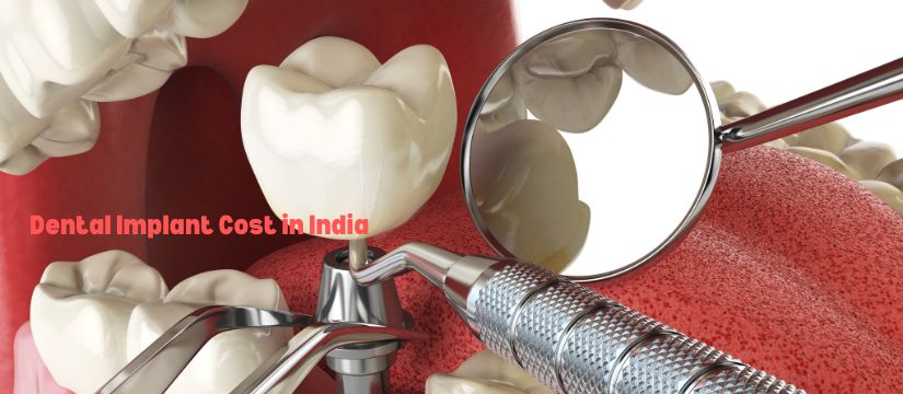 Dental Implant Cost in India