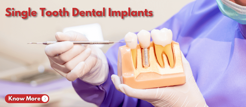 Single Tooth Dental Implants