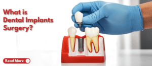 What is Dental Implants Surgery?