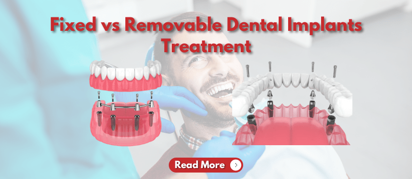 Dental Implants Treatment