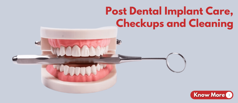 Post Dental Implant Care, Checkups and Cleaning