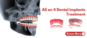 All on 4 Dental Implants Treatment